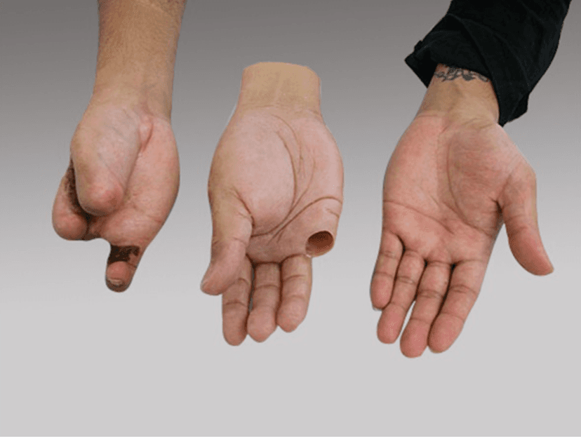 Silikon protez teknolojisi